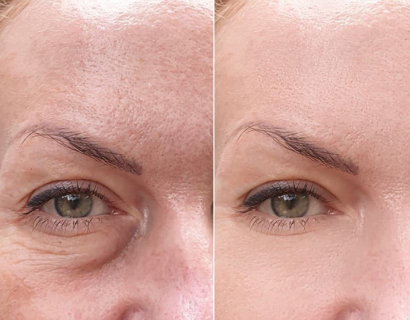 Refined contour results